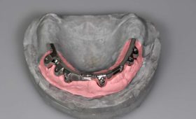 Implantatgetragener Zahnersatz