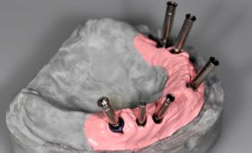 Implantatgetragener Zahnersatz