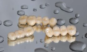 Zirkonkronen Zahnkunstwerk