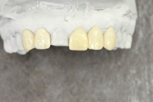 Mock-Up Zahntechnik