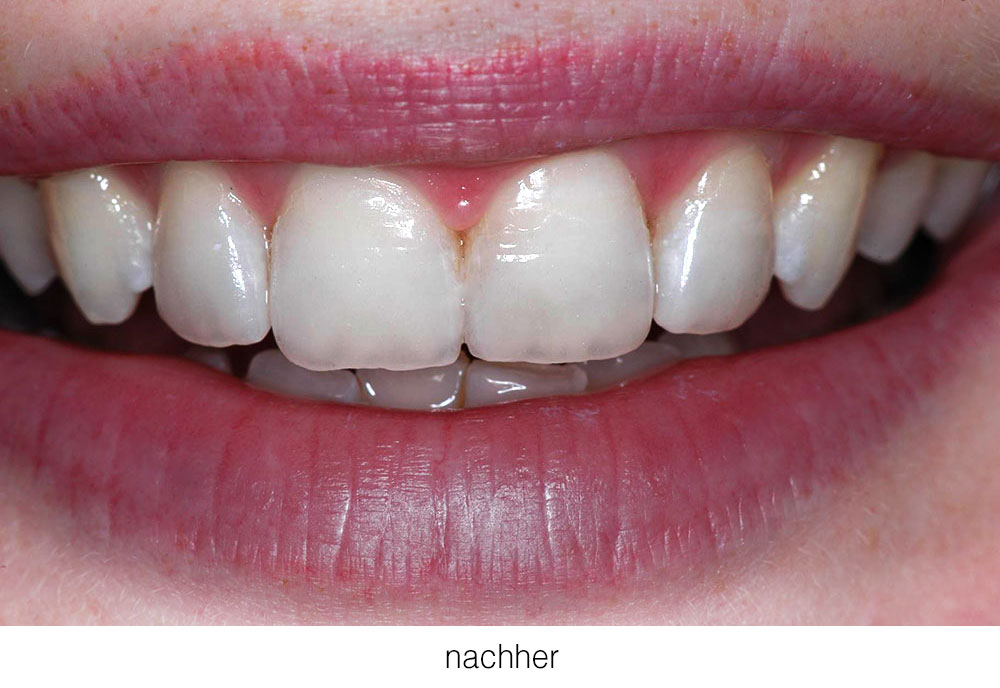 Makellose Zähne durch Veneers