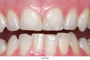 Veneers Makellose Zähne