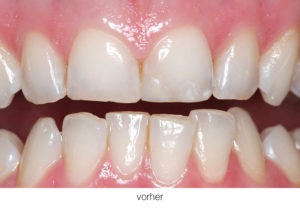 Veneers Makellose Zähne
