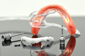 Implantatgetragener Zahnersatz: Funktion & Ästhetik